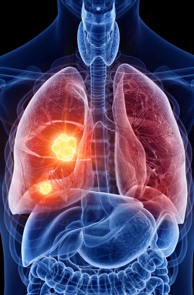 Case Study 1 - Lung Cancer
