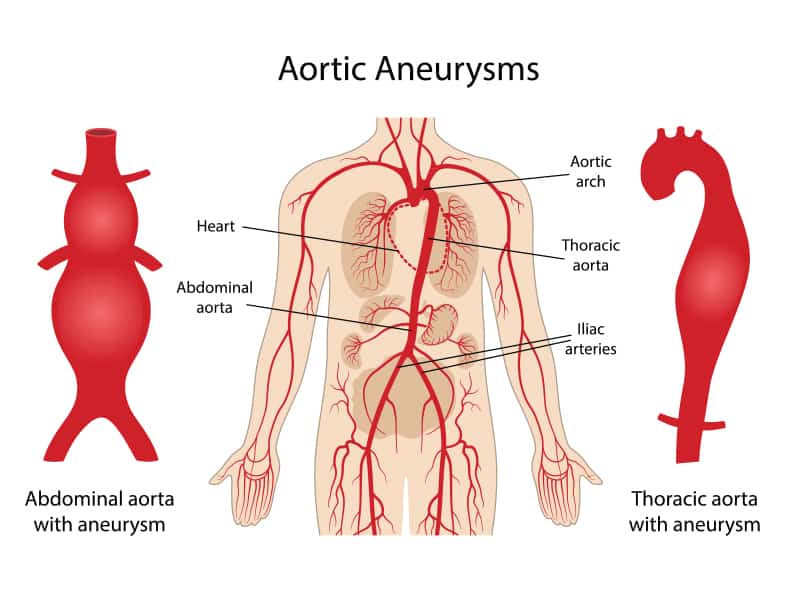 aortic aneurysm