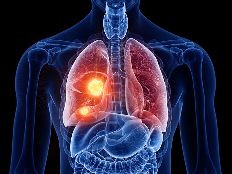 Lung cancer diagnosis - lung CT scan blog - Echelon Health