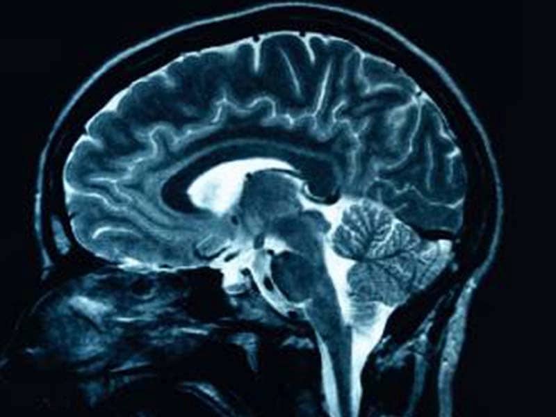 Brain Mri Scan Tesla Mri Machine Echelon Health