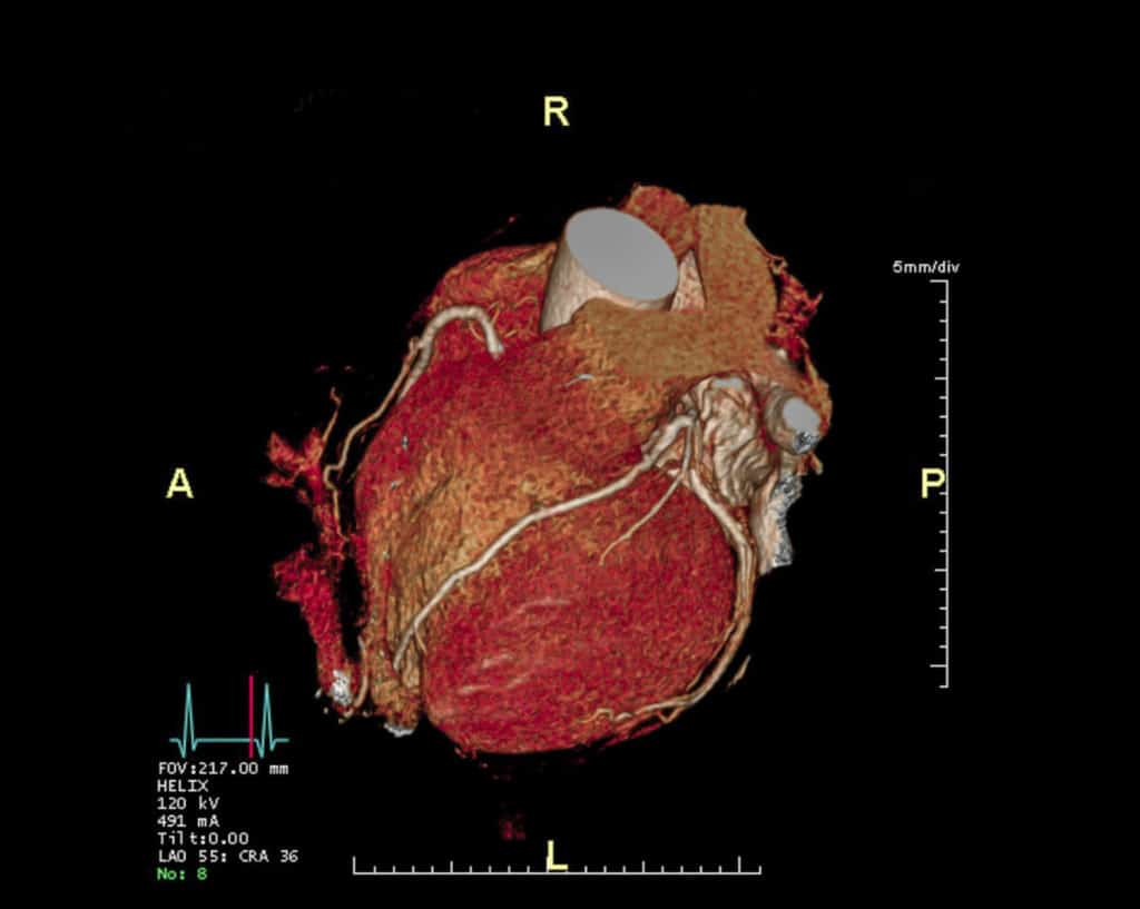 Heart CT scan
