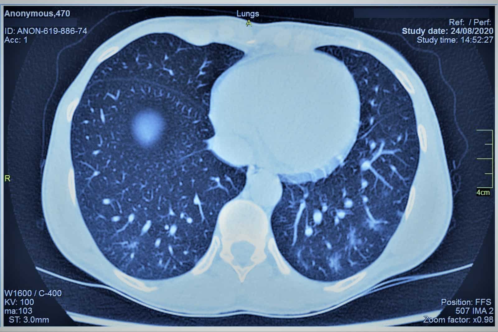 Covid Lungs X-ray