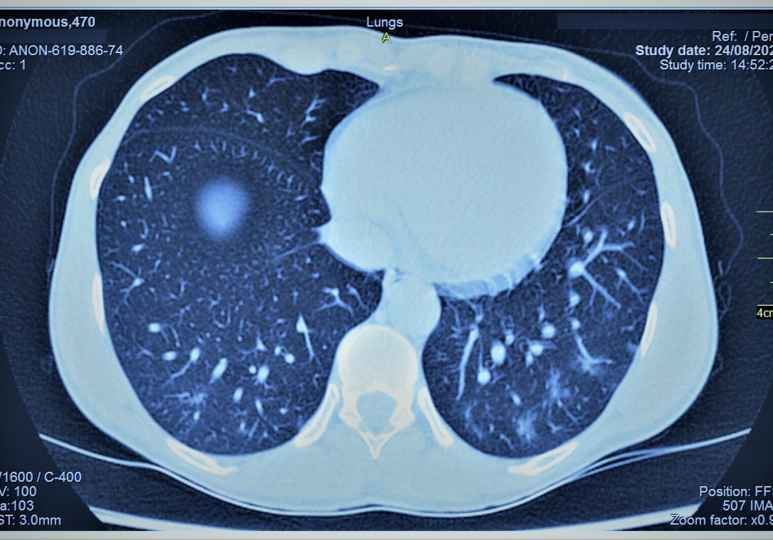 LungsScan